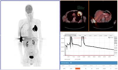 Impact of an 18F-FDG PET/CT Radiotracer Injection Infiltration on Patient Management—A Case Report